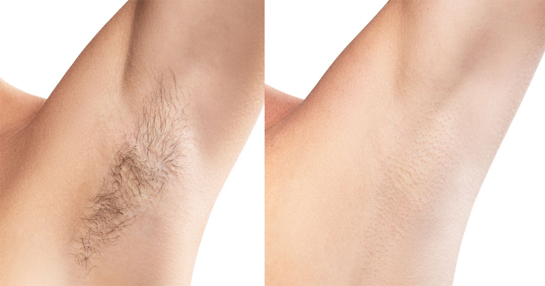 Comparaison avant/après épilation naturelle