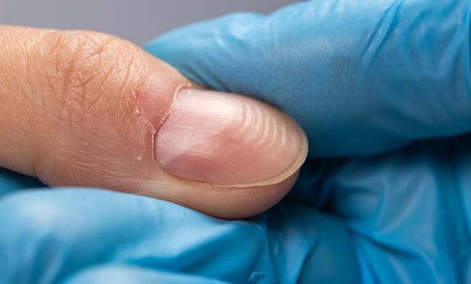 Ongles en forme de dôme