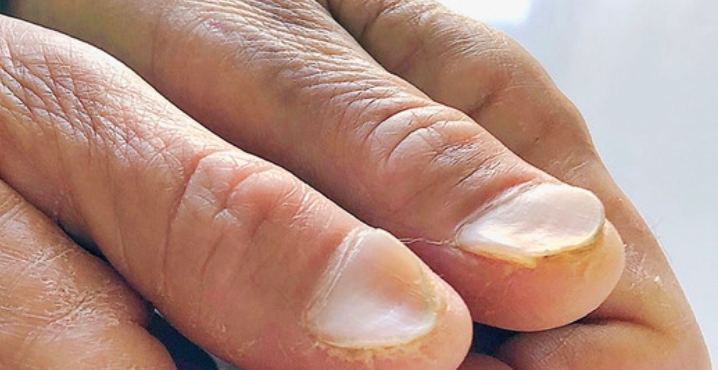 Ongle concave en forme de cuillère