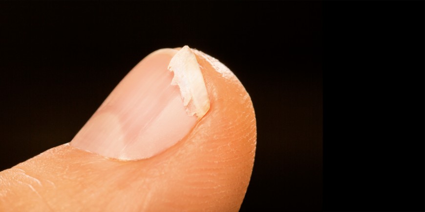 Ongles fragiles et cassants