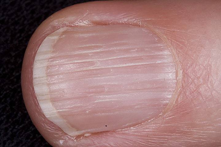 Main présentant des ongles striés