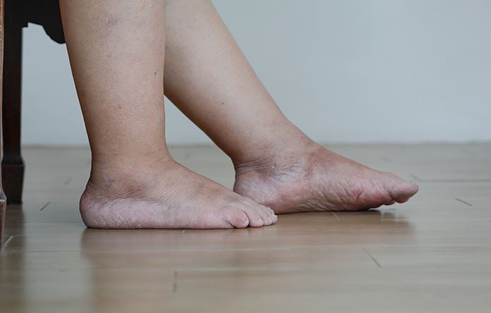 Pied gonflé nécessitant des conseils médicaux