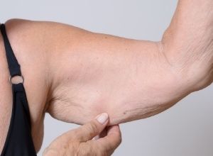 Illustration représentant la sarcopénie et ses effets sur la musculature