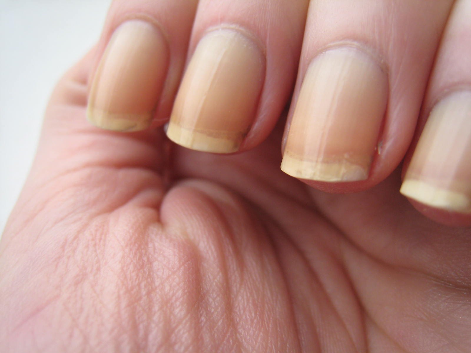 Ongles sains versus ongles jaunis