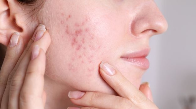 Soin des imperfections et de l'acné avec le bicarbonate