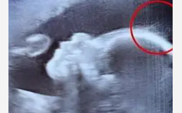 Échographie montrant une silhouette de bébé avec des détails inhabituels